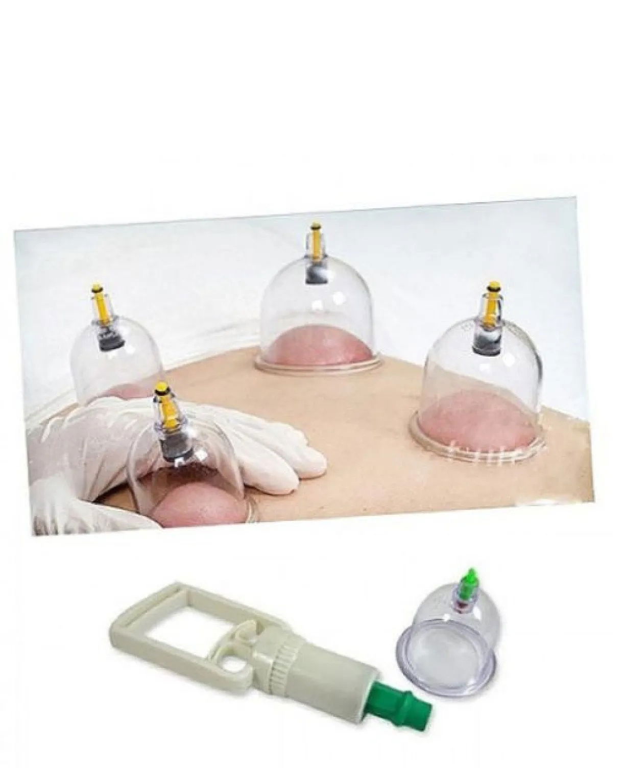 Cupping Set with Hose - Cupping Set with Vacuum Hose (Model 3)