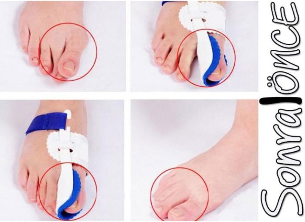 Thumb Bone Corrector Night Splint (Double)